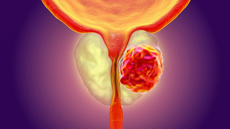 prostat hastaliklari Prostate Diseases
